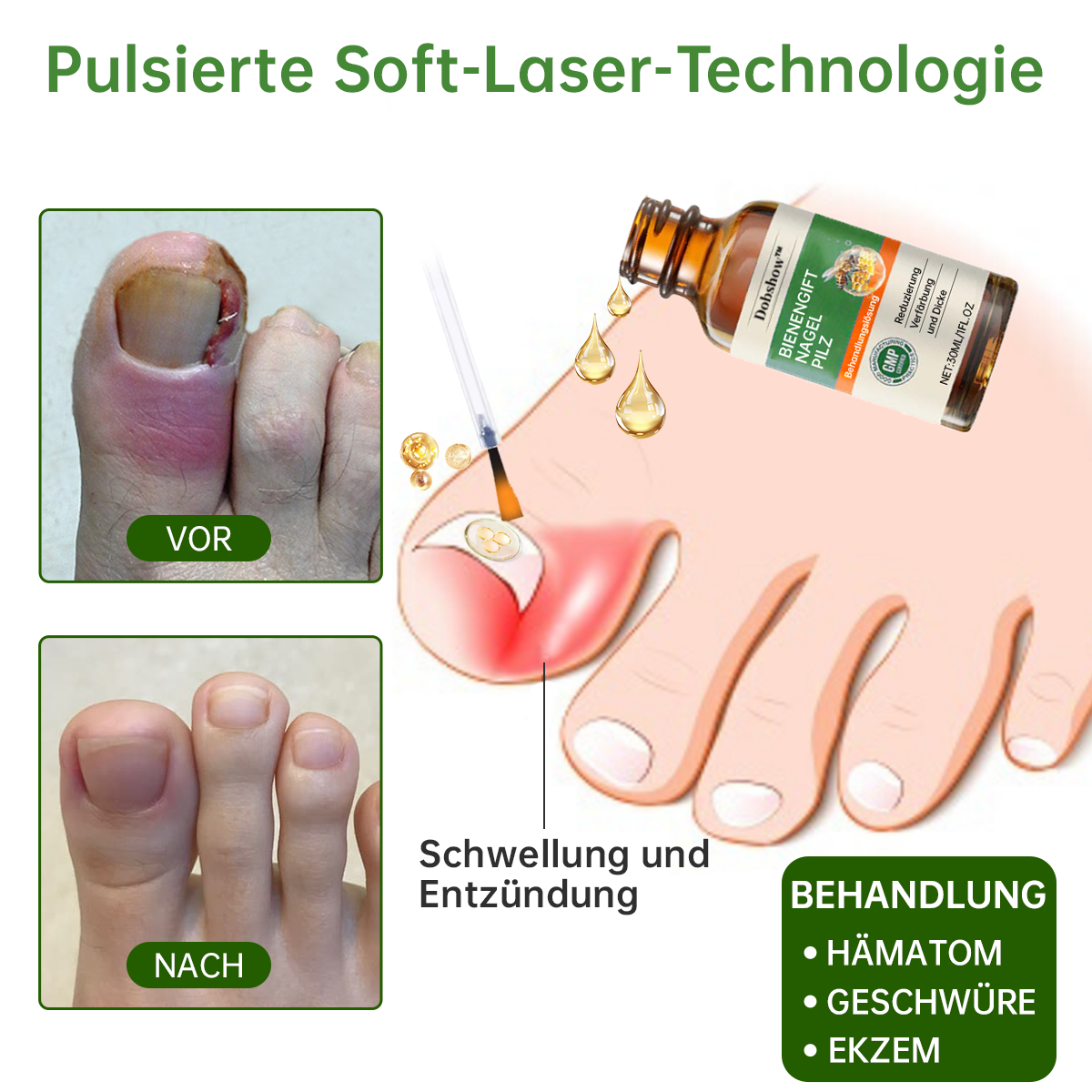 Dobshow™ Bienengift Nagelpilz-Behandlung Liquid🛡️